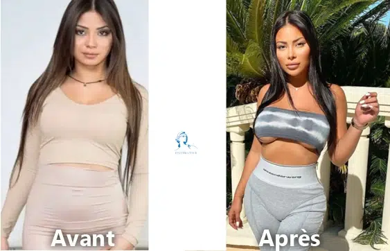 Maeva ghennam avant chirurgie esthetique tunisie