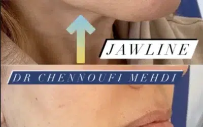 Mini lift Mini-lifting visage mini résultats