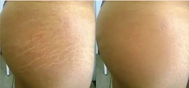 Vergetures cuisses avant apres