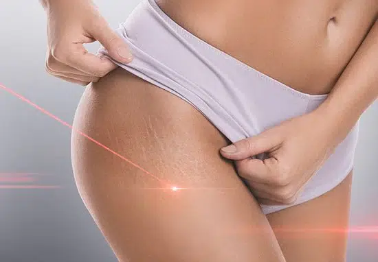 Vergetures cuisses laser