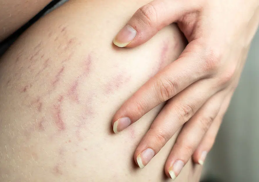 Vergetures rouges Vergetures rouges