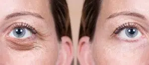 blepharoplastie 1