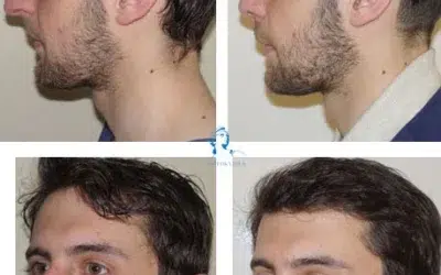 chirurgie esthetique du nez crochu Rhinoplastie pointe du nez avant apres
