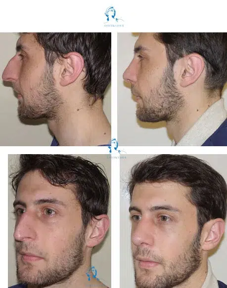 Rhinoplastie pointe du nez avant apres