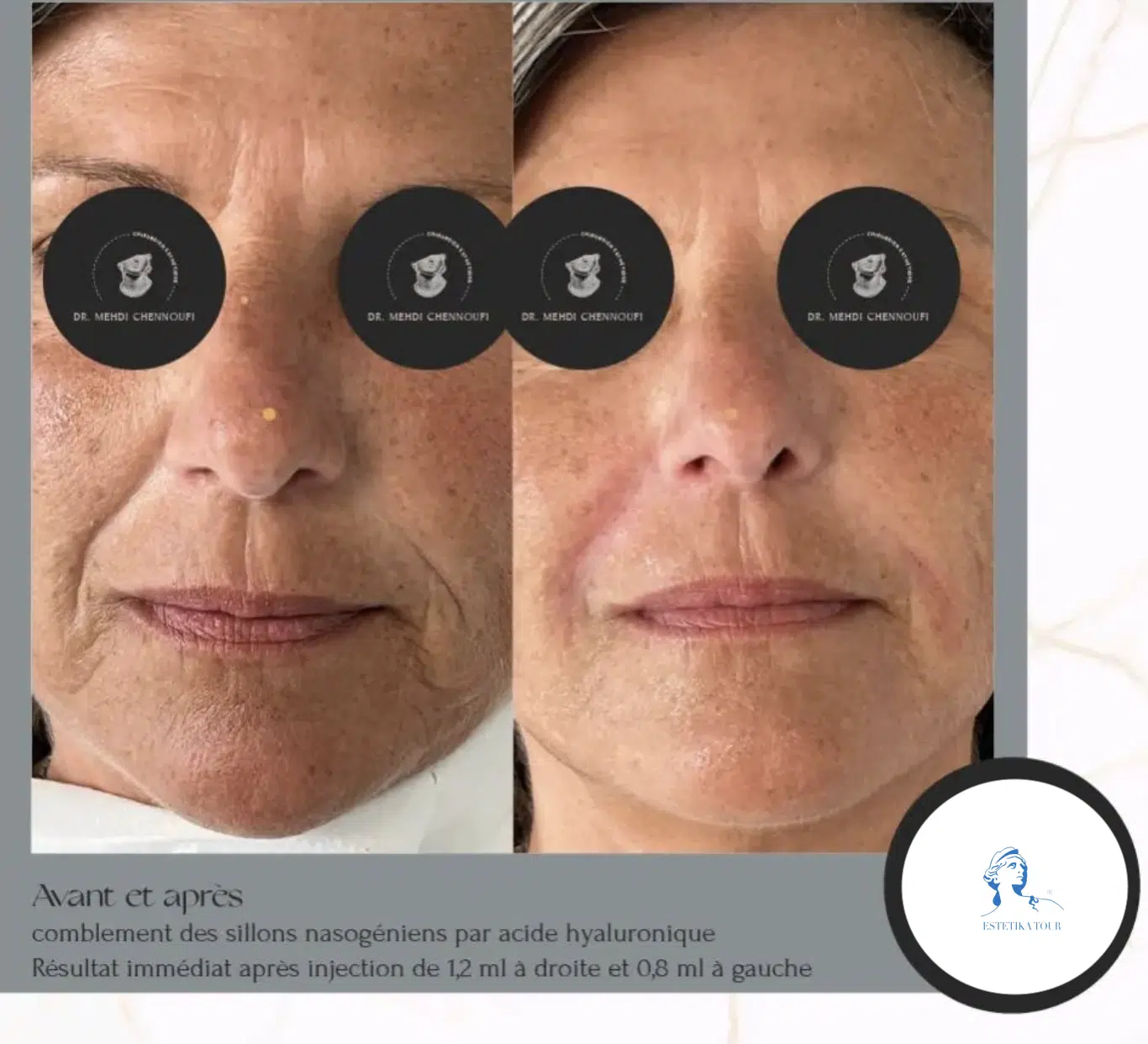 chirurgie esthétique visage avant et après