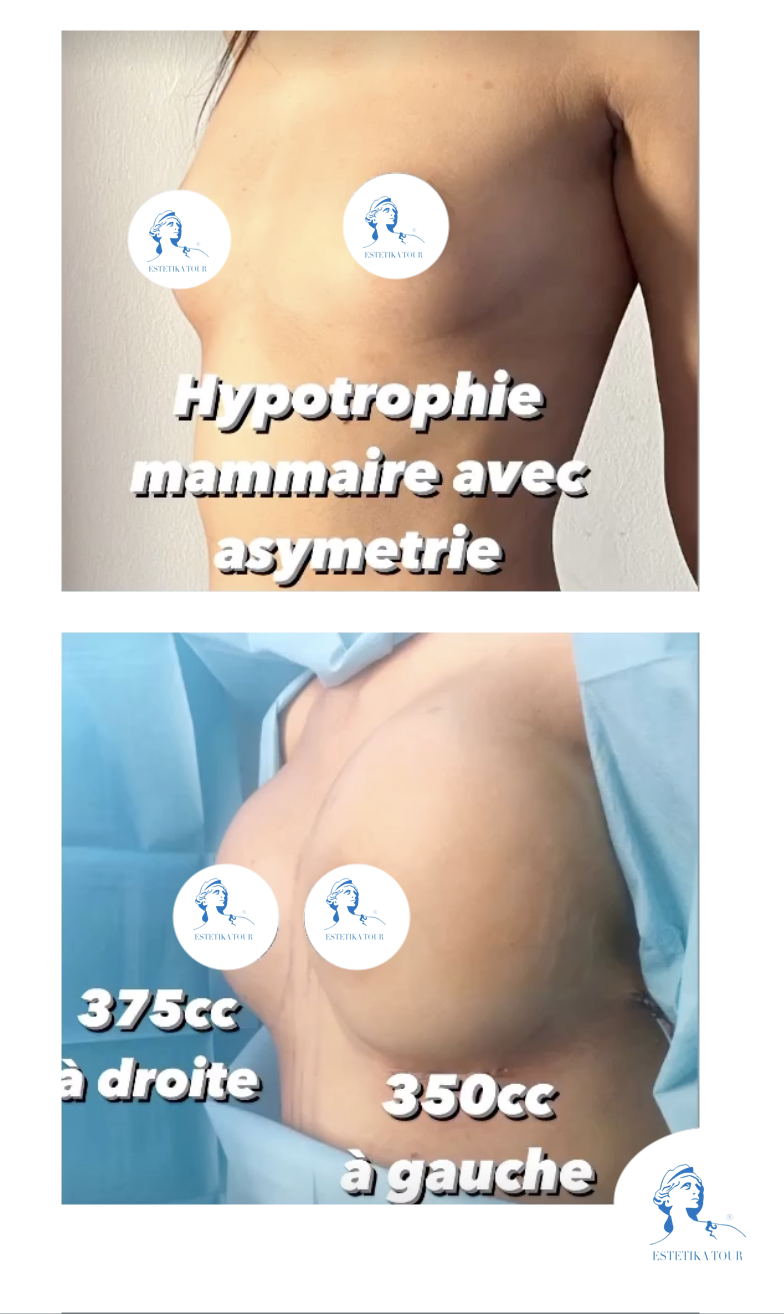 hypertrophie mammaire pour une augmentation volume des seins