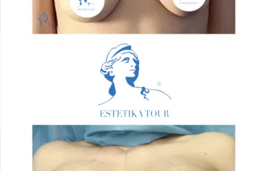 lifting et augmentation mammaire avec implants avant apres augmentation mammaire