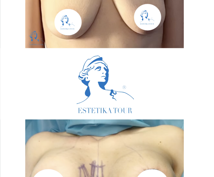 Lifting des seins en tunisie, avant apres augmentation mammaire