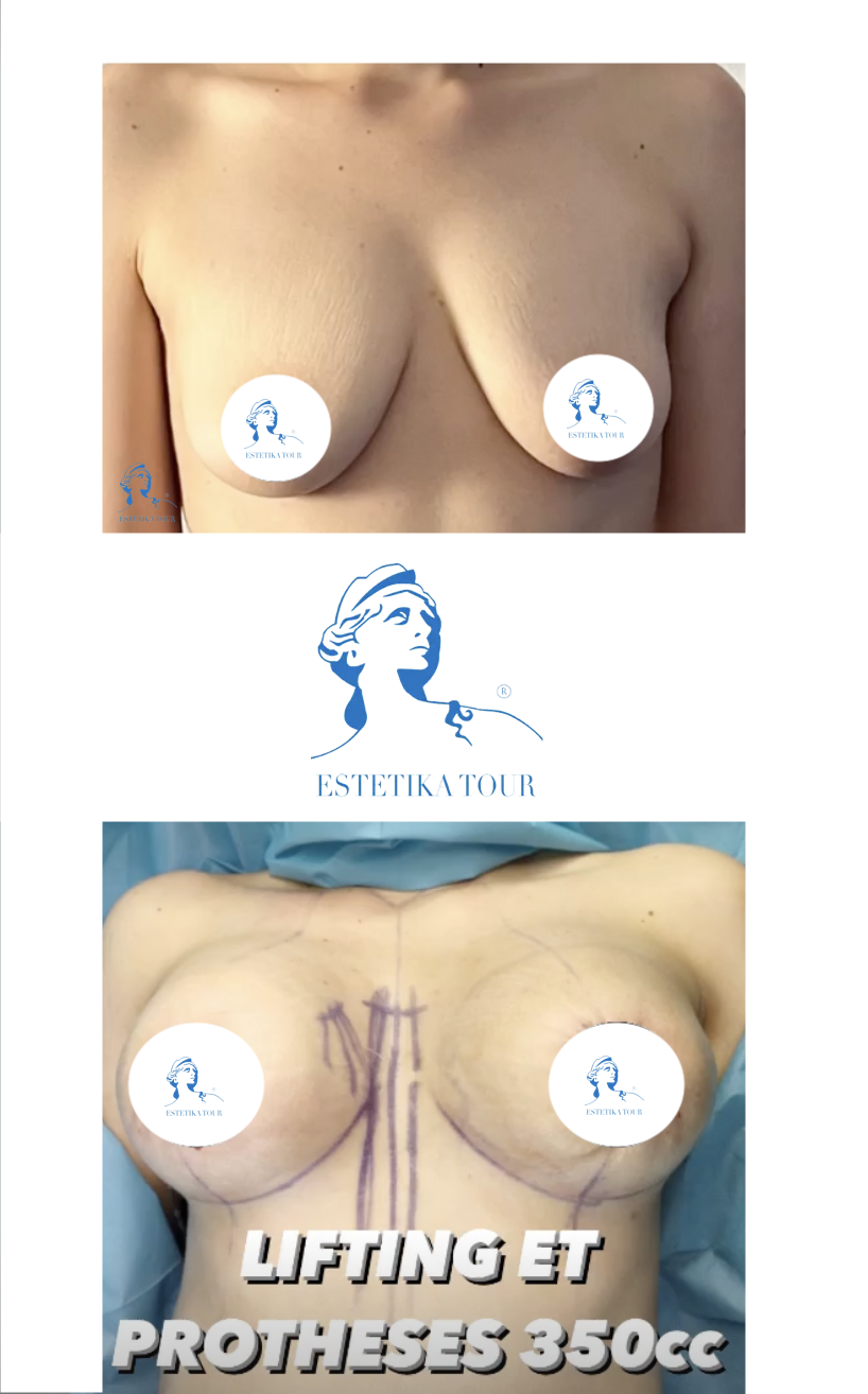 lifting et augmentation mammaire avec implants