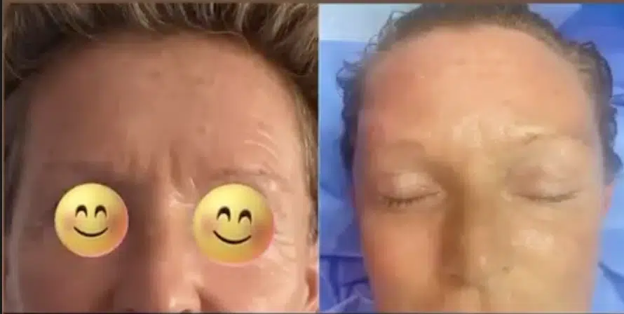 Lifting frontal prix