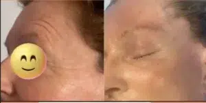 chirurgie esthétique visage avant et après, Comment se débarrasser cernes poches yeux