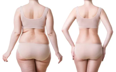 liposuccion cuisse avant apres tunisie liposuccion