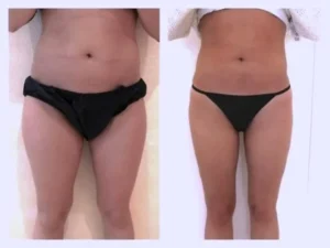 liposuccion cuisse avant après et liposculpture