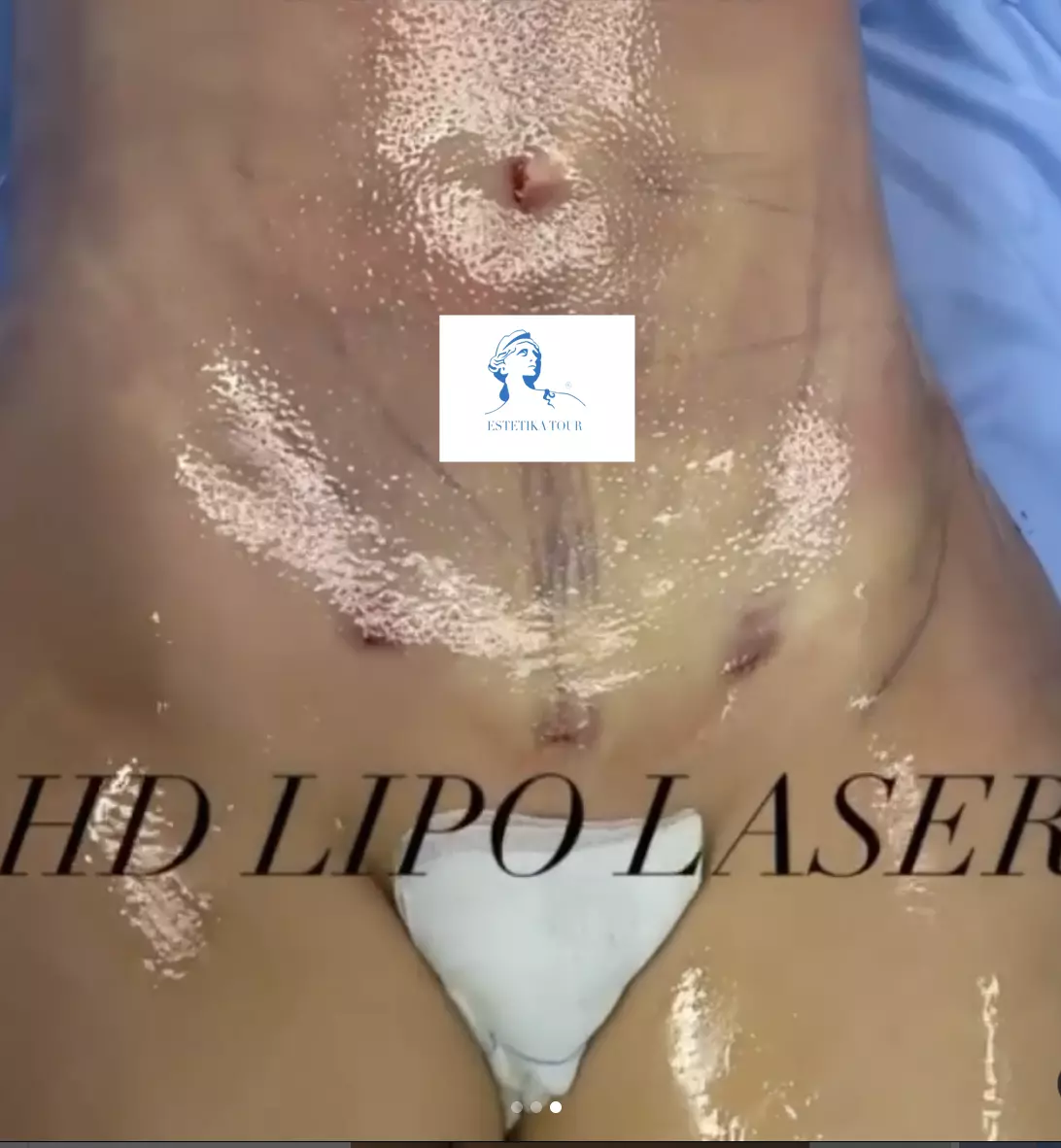 liposuccion hd laser