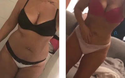 liposuccion liposculpture liposuccion apres perte de poids