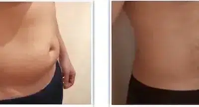 liposuccion ventre et des poignees d amour chez un homme Déconfinement en Tunisie; covid 19 et chirurgie esthétique
