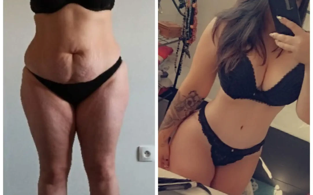 Liposuccion laser
