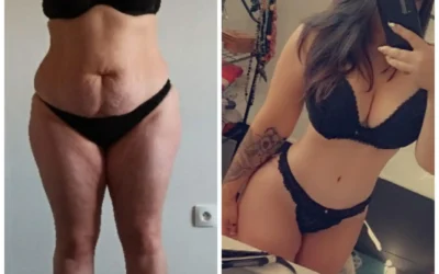 Liposuccion laser