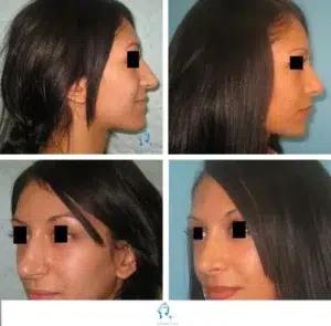 rhinoplastie chirurgie du nez