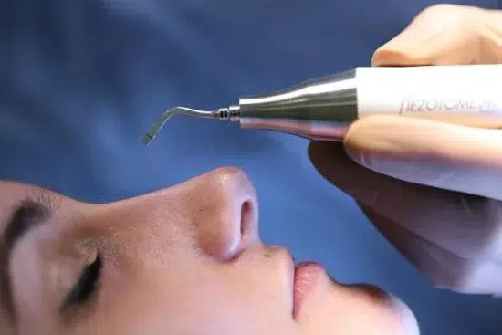 Rhinoplastie ultrasonique dr gerbault