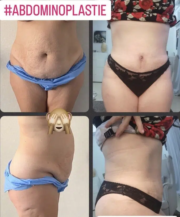 Résultat abdominoplastie tunisie