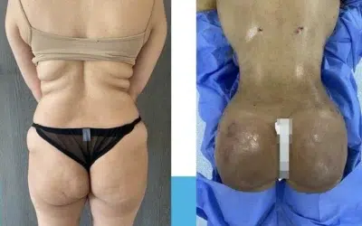 Faire le lipofiling des fesses