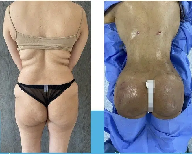 faire le lipofiling des fesses