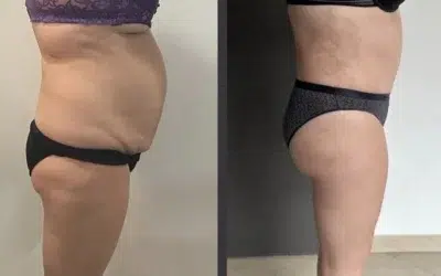 chirurgie abdominoplastie tunisie