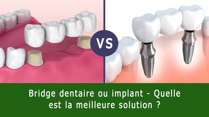 refaire ses dents bridge ou implant dentaire tunisie