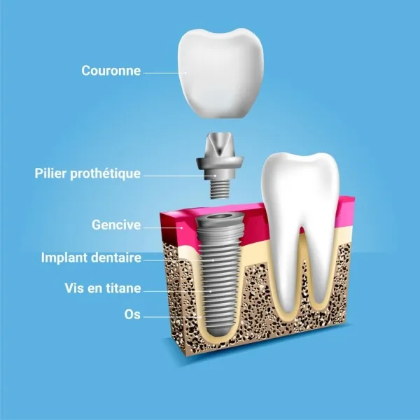 implant dentaire Tunisie
