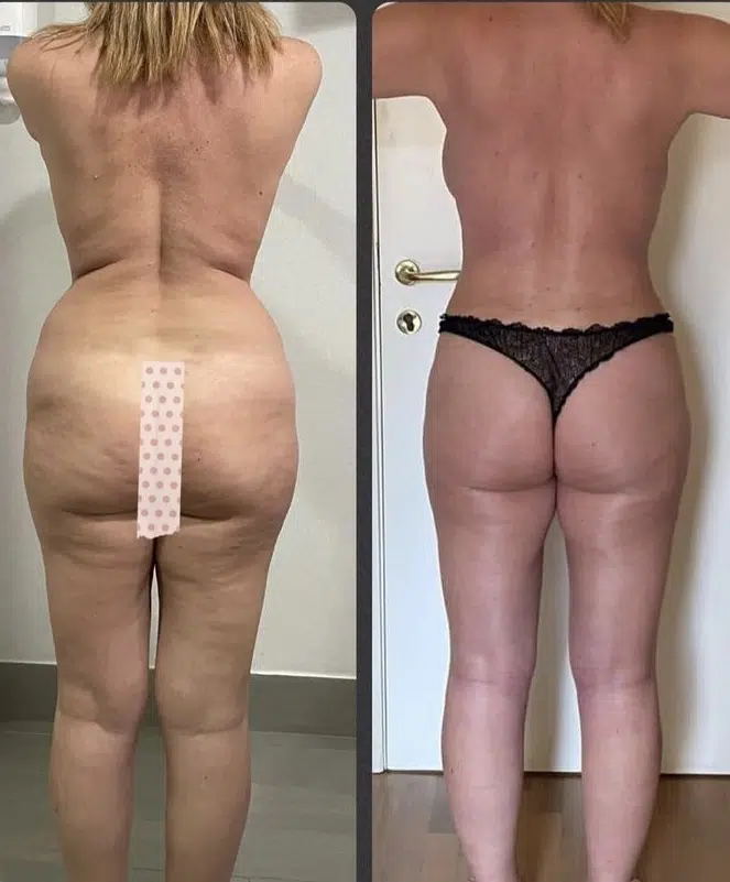 resultat lipoaspiration