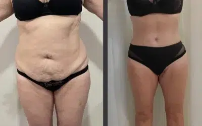 Avant apres lifting du ventre Chirurgie surplus de peau prix
