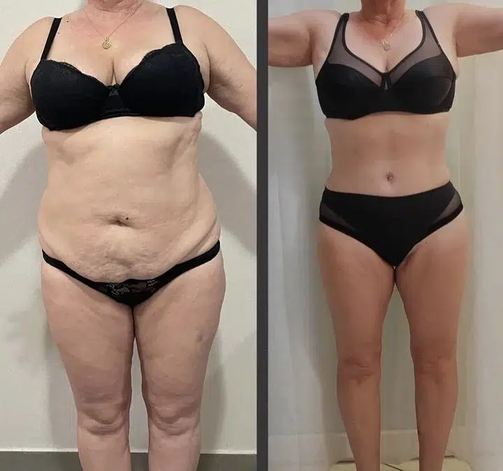 Chirurgie surplus de peau prix