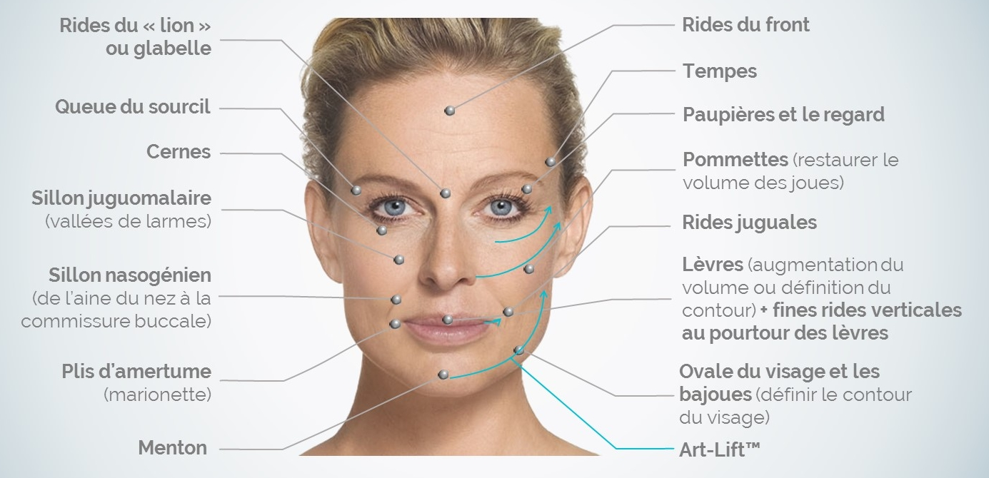 Injection Acide Hyaluronique Estetika