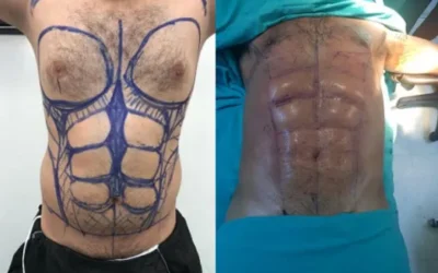 Liposuccion Homme adipomastie homme