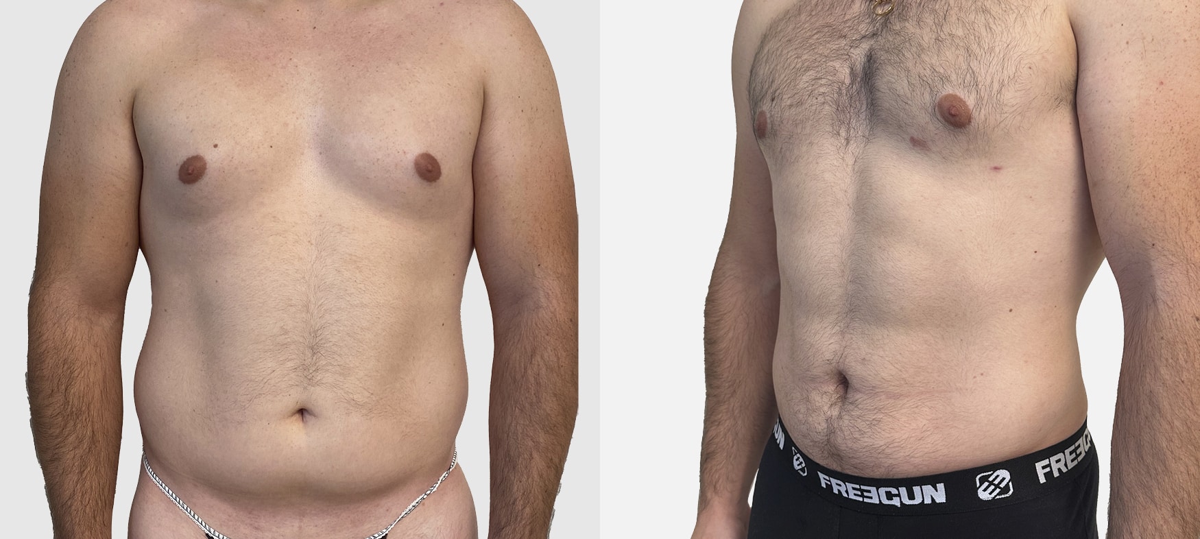 Liposuccion homme ventre