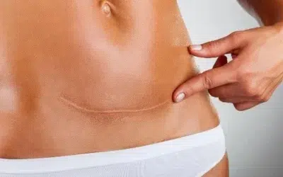 abdominoplastie cicatrice Abdominoplastie 1 an après cicatrice