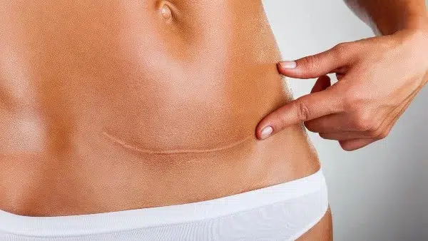 Abdominoplastie 1 an après