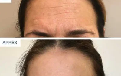 botox visage 1 Botox visage injections toxine Botulique