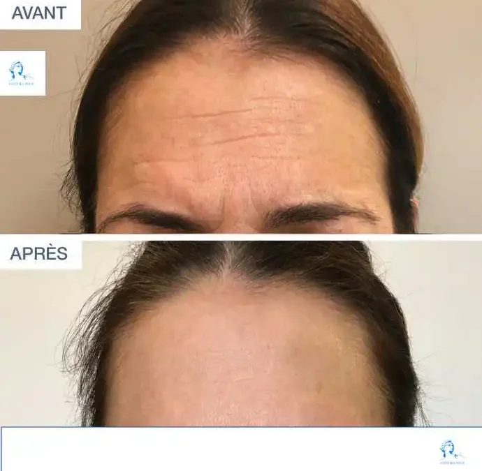 Botox visage injections toxine Botulique