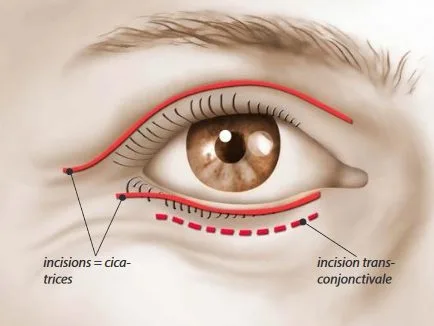 blepharoplastie prix