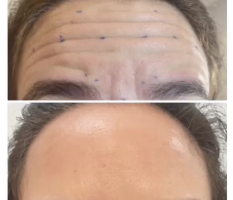 Injection botox