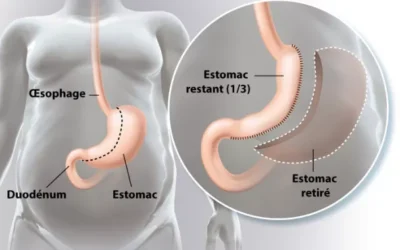 sleeve gastrique Quel est le prix d’une sleeve ?