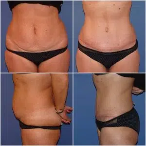 abdominoplastie avant et après