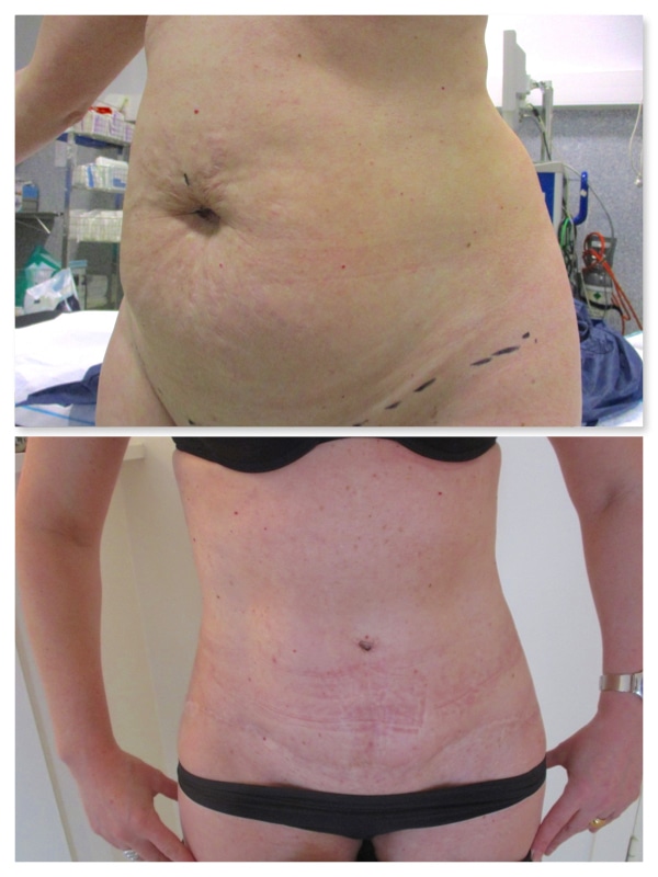 Abdominoplastie 2 mois après estetika