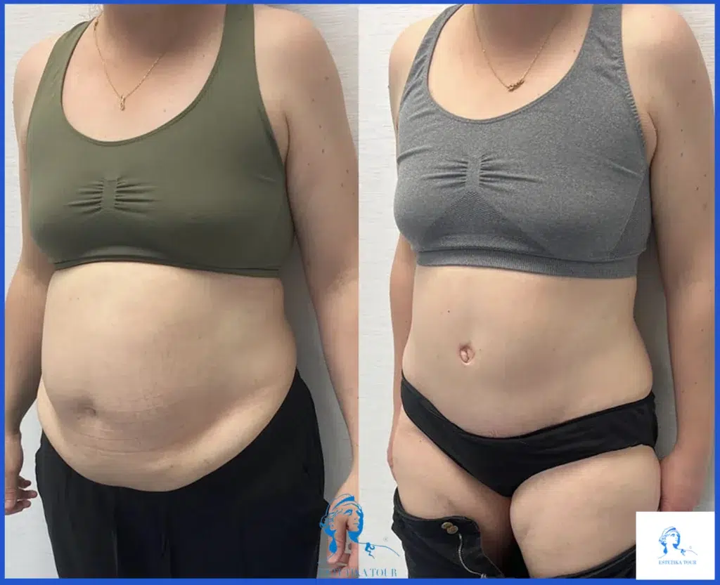 Peut on reprendre du ventre après une abdominoplastie : poids et paroi abdominal, abdominoplastie après, Appréhensions patients à propos de l'abdominoplastie,