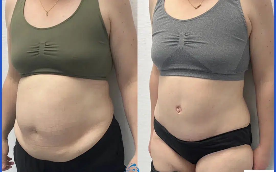 Peut on reprendre du ventre après une abdominoplastie : poids et paroi abdominal