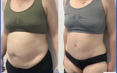 Abdominoplastie opération du ventre