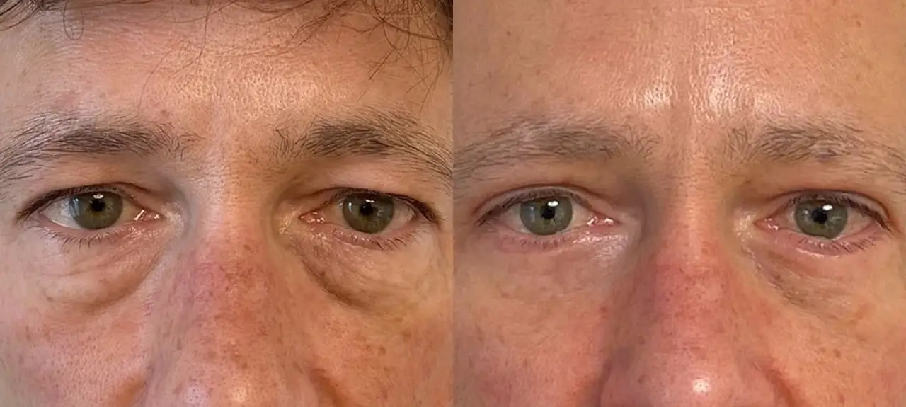 Photo avant et après blépharoplastie des 4 paupières chez un homme de 60 ans.
