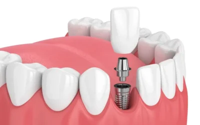 Implant dentaire prix